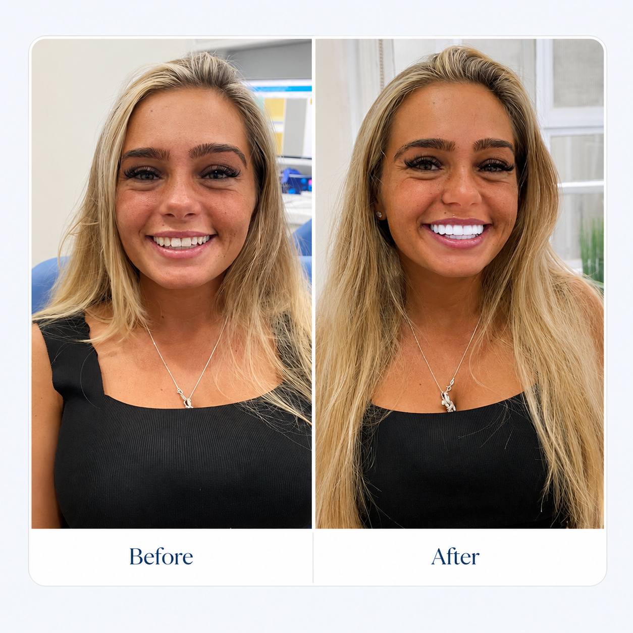 Before and after smile transformation