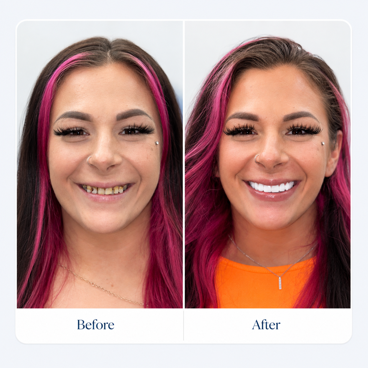 Before and after smile transformation