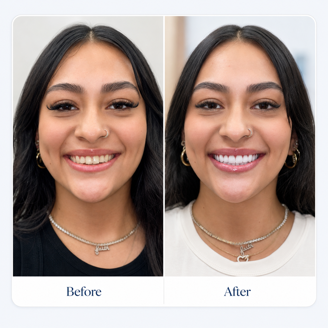 Before and after smile transformation