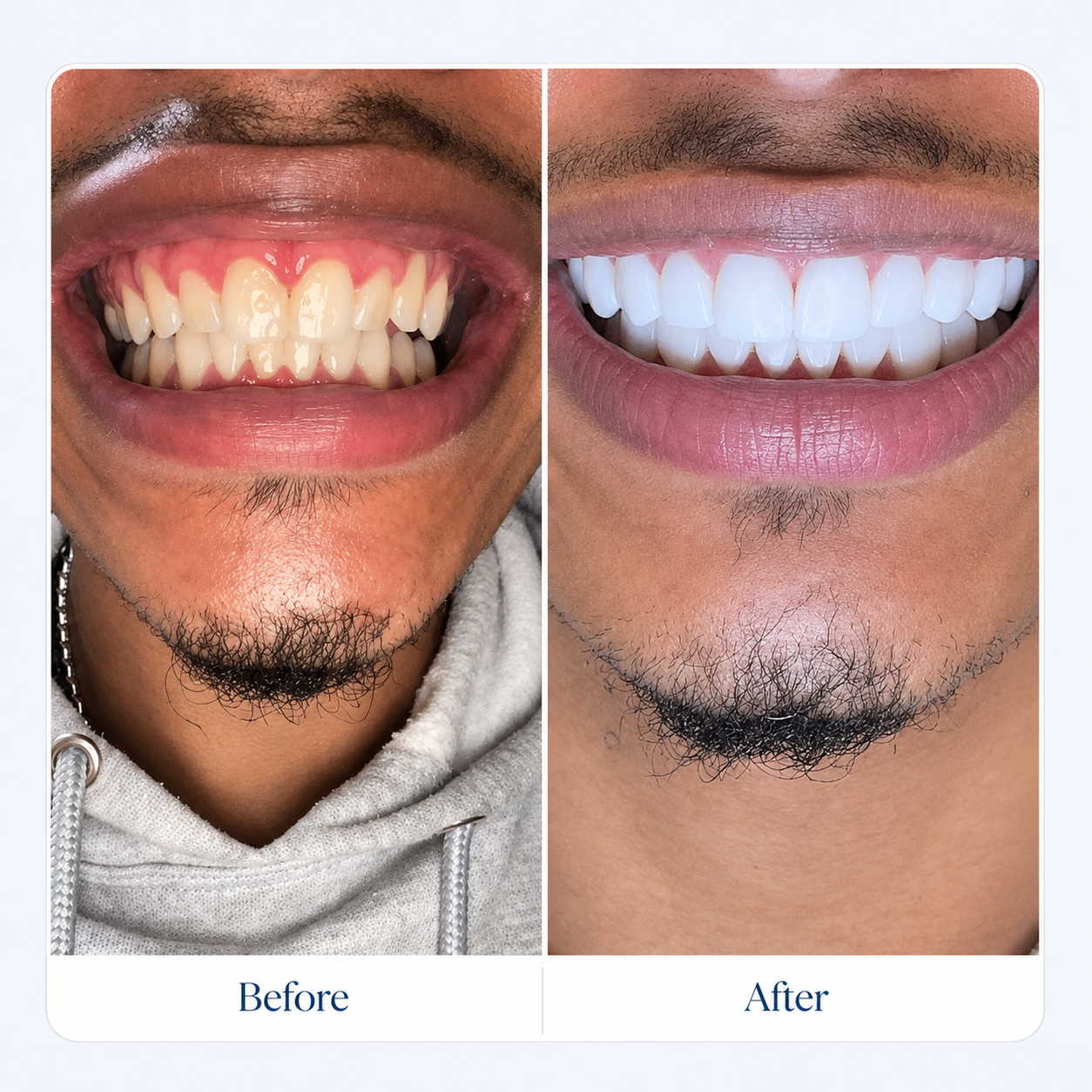 Before and after smile transformation