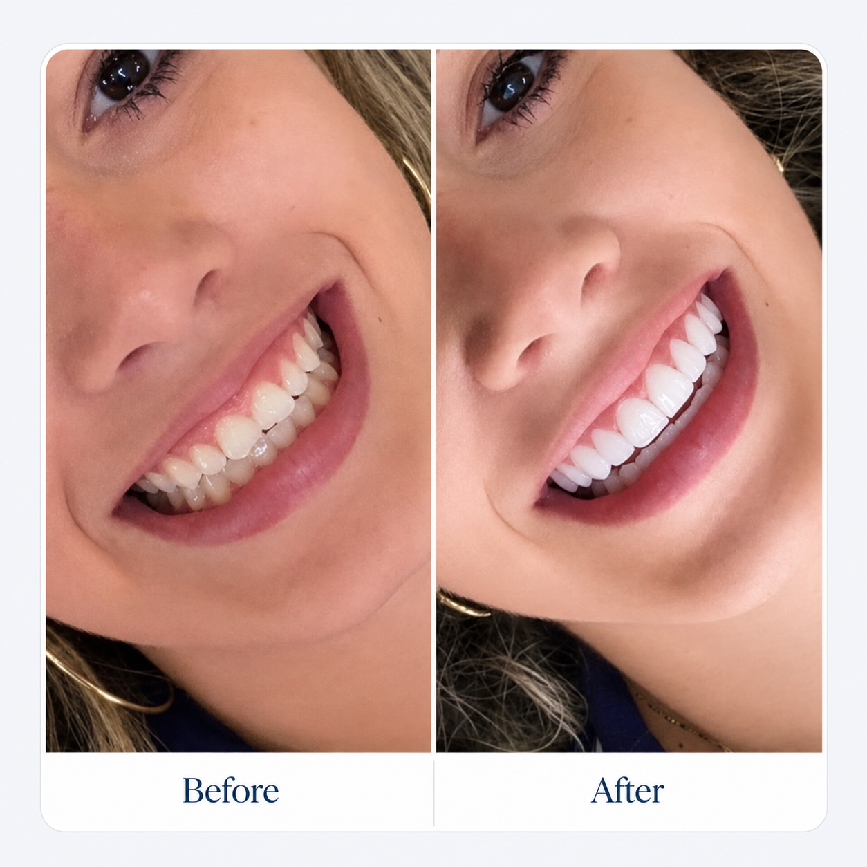 Before and after smile transformation
